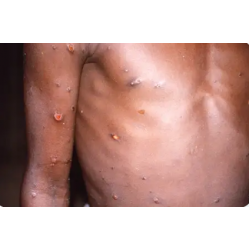 Mpox: conheça sintomas e tire principais dúvidas sobre a doença